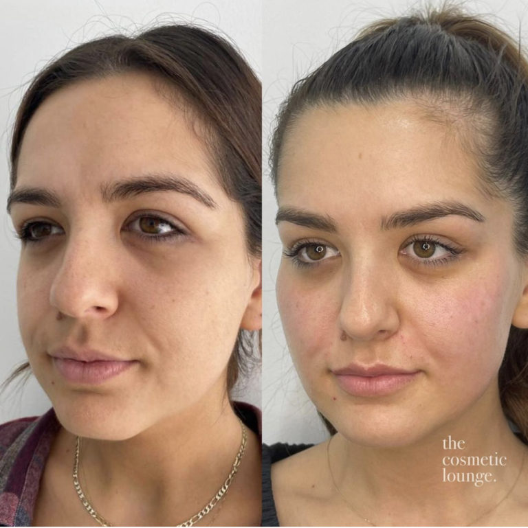 Facial Reshaping and Facial Slimming - Facelove - St Kilda, Melbourne